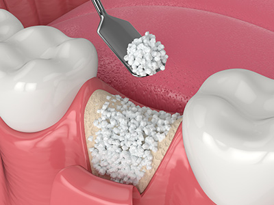 M. Kurt Berky, DDS, PC | Crown Lengthening, Oral Exams and Full Mouth Reconstruction