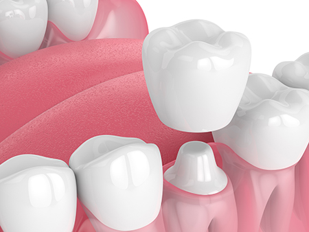 M. Kurt Berky, DDS, PC | Emergency Treatment, Ceramic Crowns and Periodontal Treatment